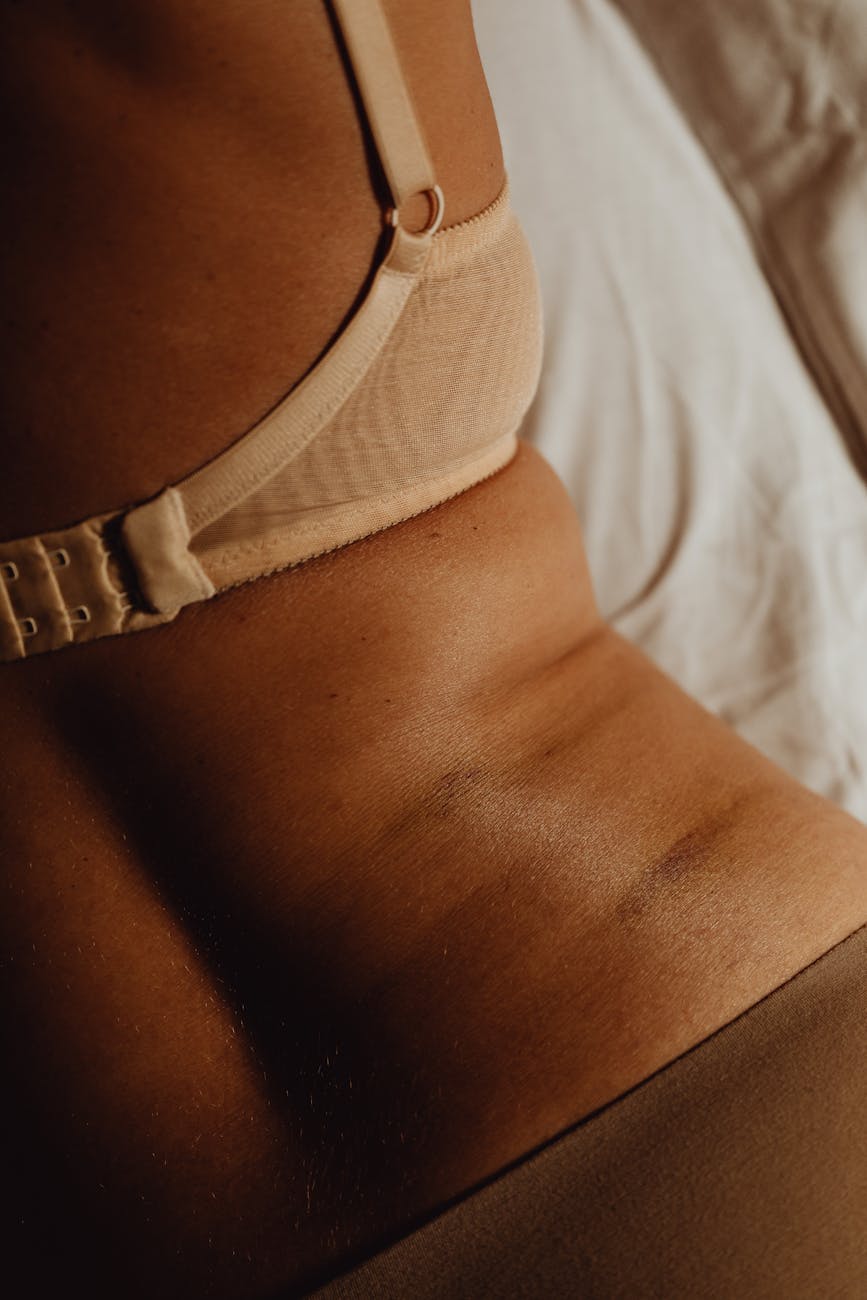 a woman with skin discoloration wearing bra and underwear